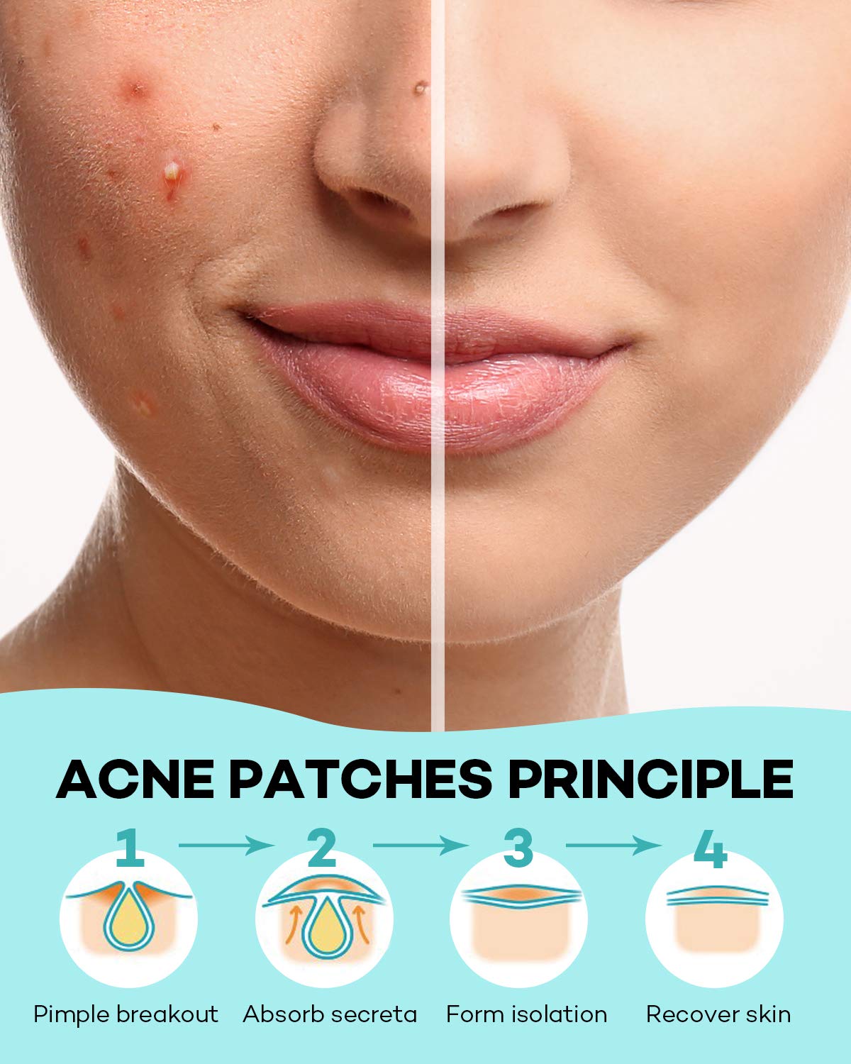 Acne Patch Pimple Patch, 4 Sizes 140 Patches Acne Absorbing Cover Patch, Hydrocolloid Invisible Acne Patches For Face Zit Patch Acne Dots Tea Tree, Calendula Oil ? ? ? ? ? - Image 6